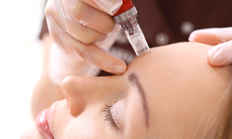 Microneedling per cicatrici e rugosità sottili